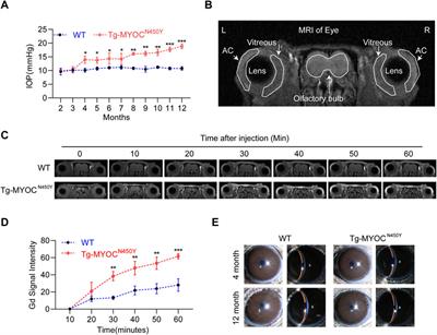 Myocilin Gene Mutation Induced Autophagy Activation Causes Dysfunction of Trabecular Meshwork Cells